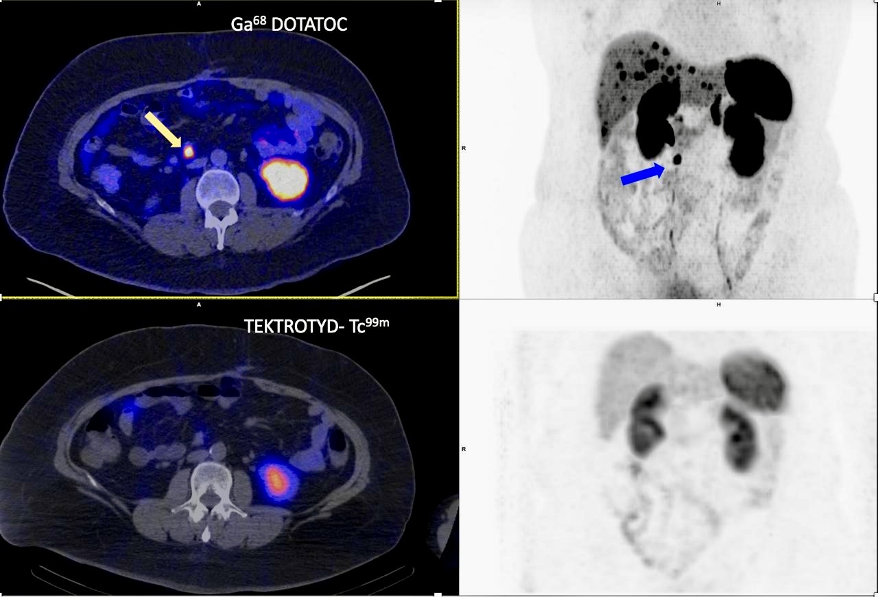 Imagen clínica con Ga68-DOTATOC y Tektrotyd-Tc99m utilizada en una ponencia sobre cirugía radioguiada en Burgos